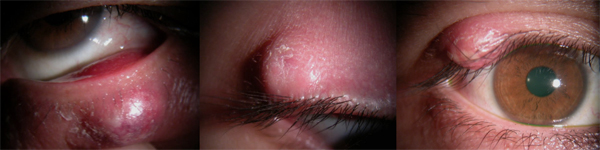 一般眼科 茨木市白川のくぼた眼科 ものもらい アレルギー疾患